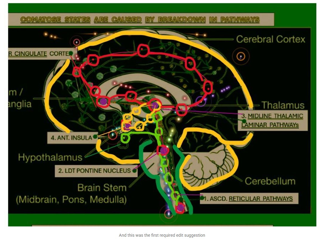Coma State — Pathway Attractors